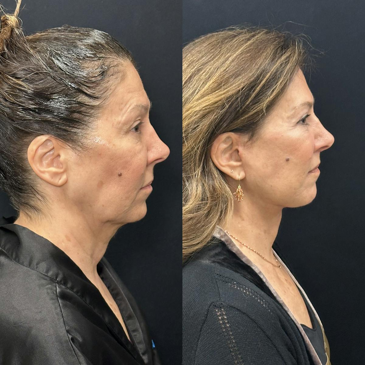 Deep Plane Facelift Before & After Gallery - Patient 931041 - Image 3