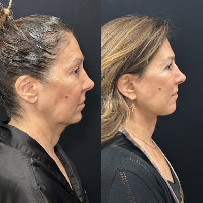 Deep Plane Facelift Before & After Gallery - Patient 931041 - Image 3