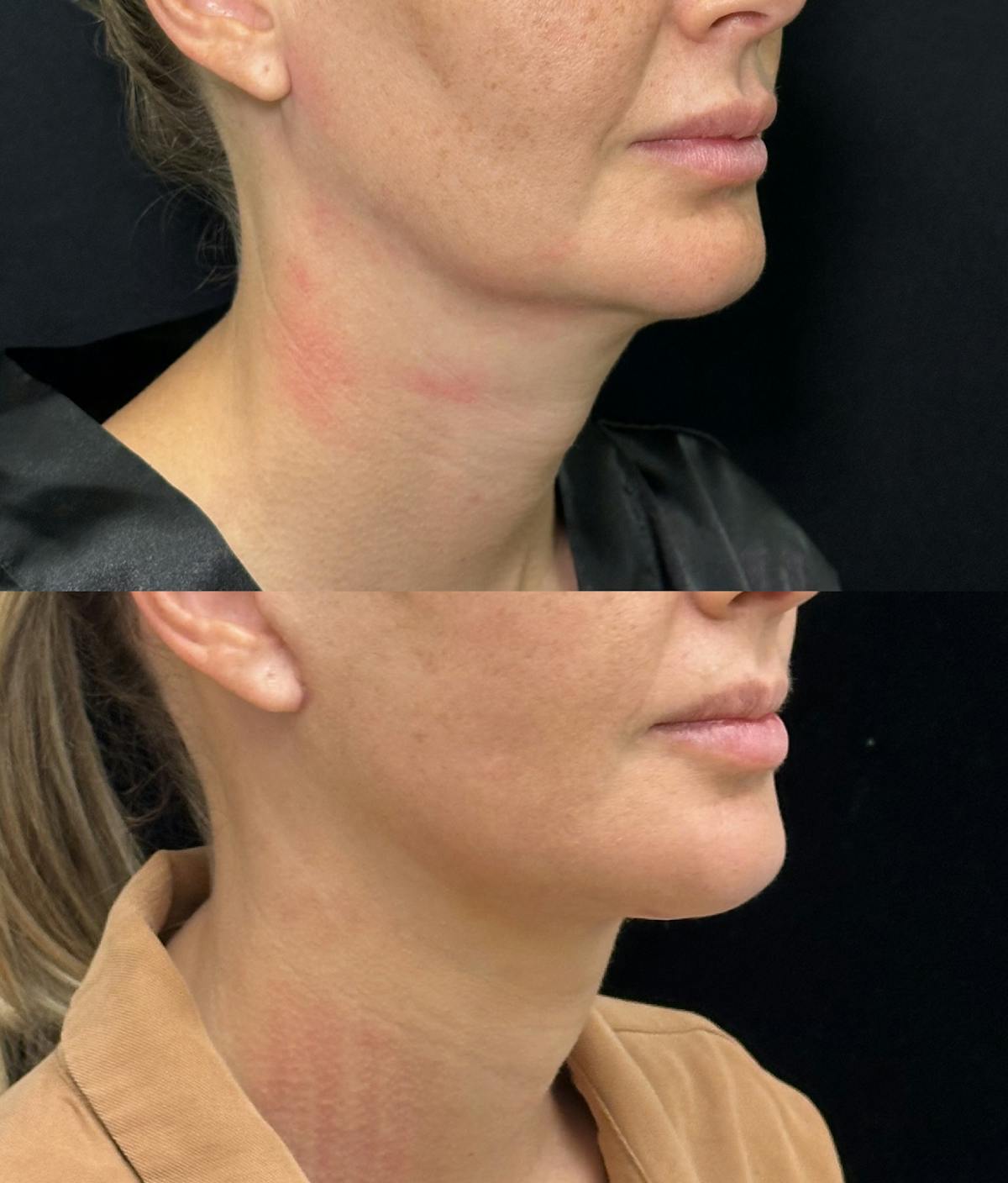 Deep Plane Facelift Before & After Gallery - Patient 396938 - Image 2