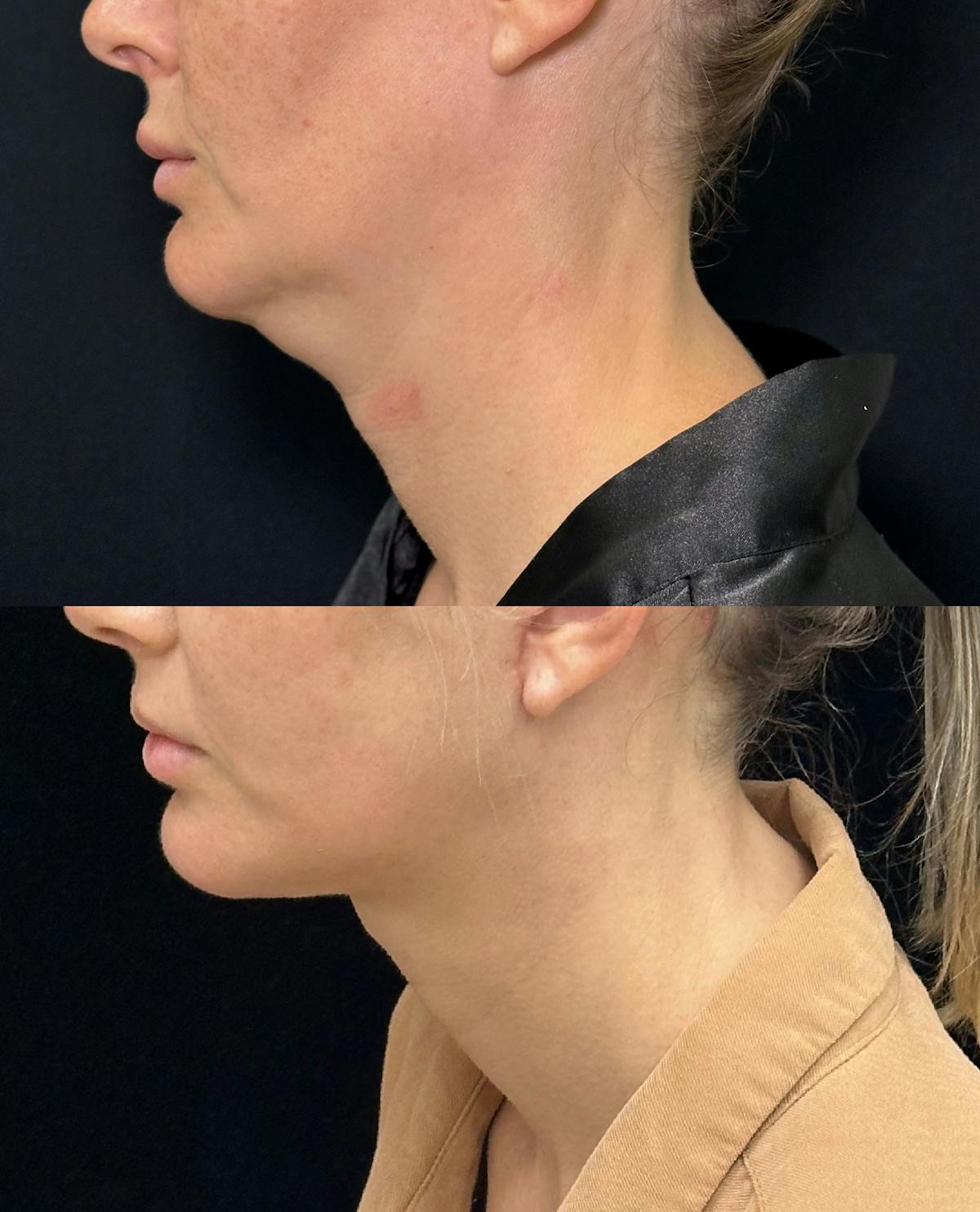 Deep Plane Facelift Before & After Gallery - Patient 396938 - Image 4