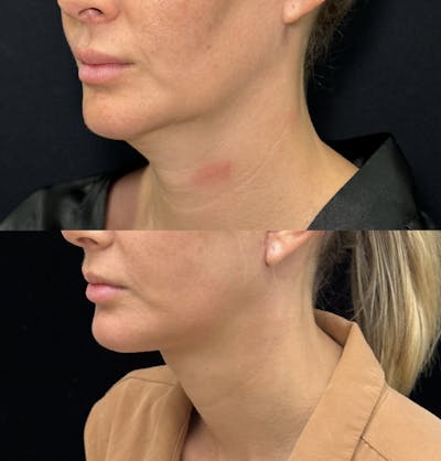 Deep Plane Facelift Before & After Gallery - Patient 396938 - Image 3
