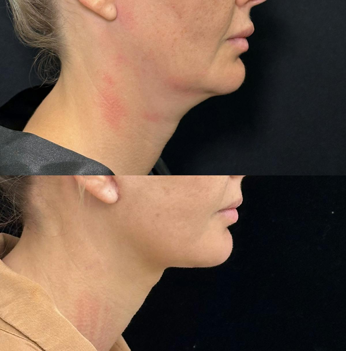 Deep Plane Facelift Before & After Gallery - Patient 396938 - Image 1