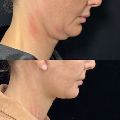 Deep Plane Facelift Before & After Gallery - Patient 396938 - Image 5