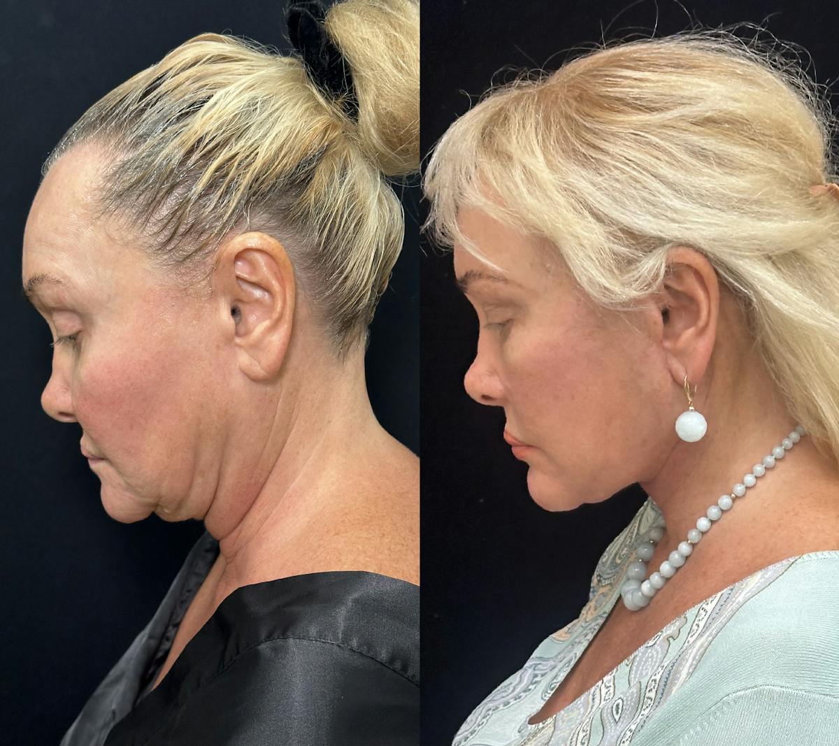 Deep Plane Facelift Before & After Gallery - Patient 205584 - Image 2