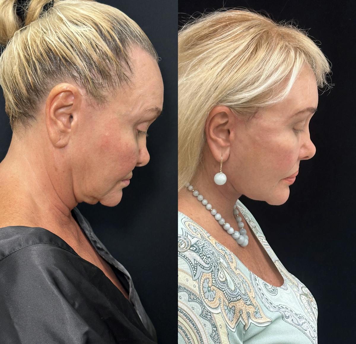 Deep Plane Facelift Before & After Gallery - Patient 205584 - Image 1