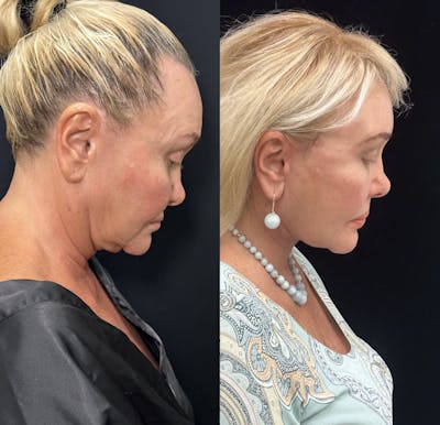 Deep Plane Facelift Before & After Gallery - Patient 205584 - Image 1