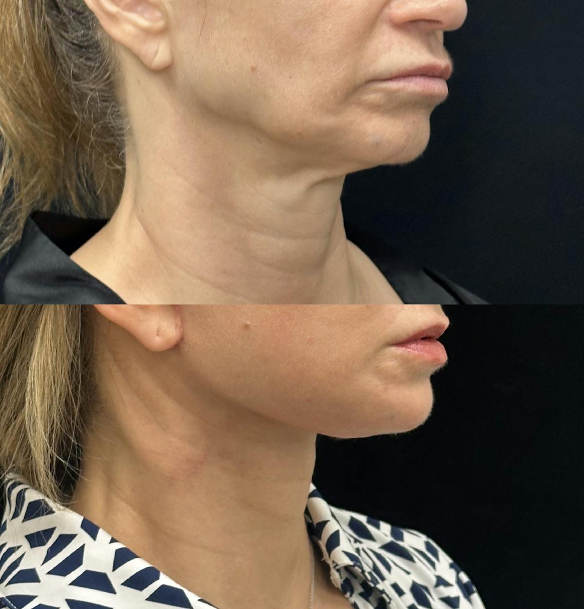Deep Plane Facelift Before & After Gallery - Patient 228793 - Image 2
