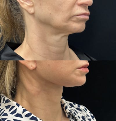Deep Plane Facelift Before & After Gallery - Patient 228793 - Image 2