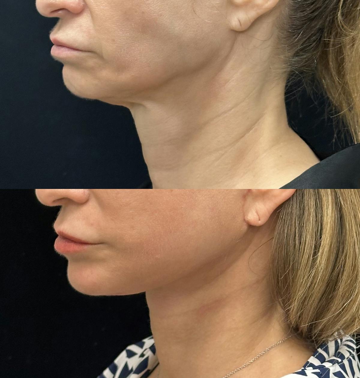 Deep Plane Facelift Before & After Gallery - Patient 228793 - Image 3