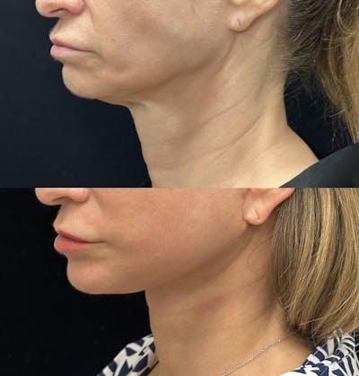 Deep Plane Facelift Before & After Gallery - Patient 228793 - Image 3