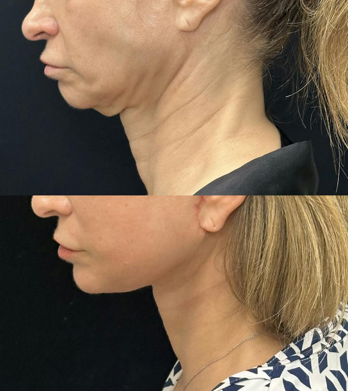 Deep Plane Facelift Before & After Gallery - Patient 228793 - Image 4