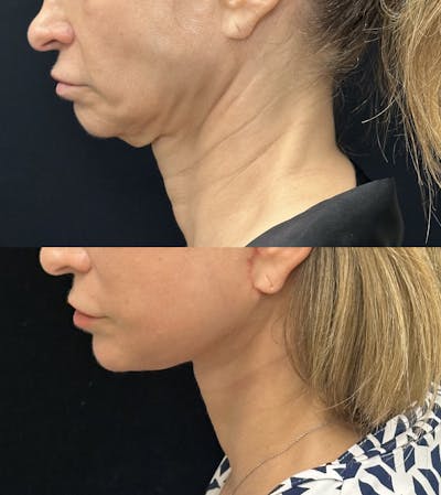 Deep Plane Facelift Before & After Gallery - Patient 228793 - Image 4