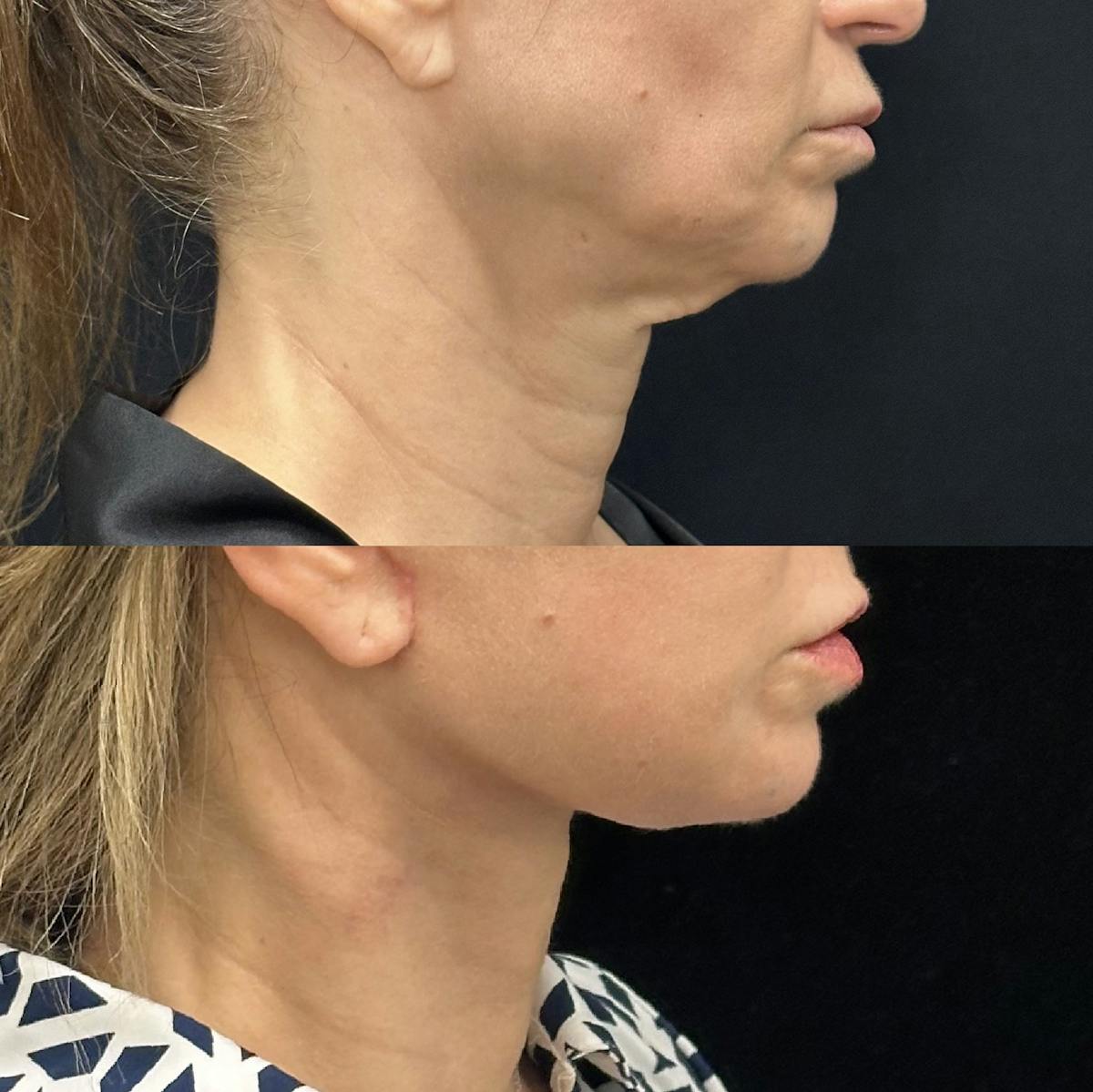 Deep Plane Facelift Before & After Gallery - Patient 228793 - Image 1