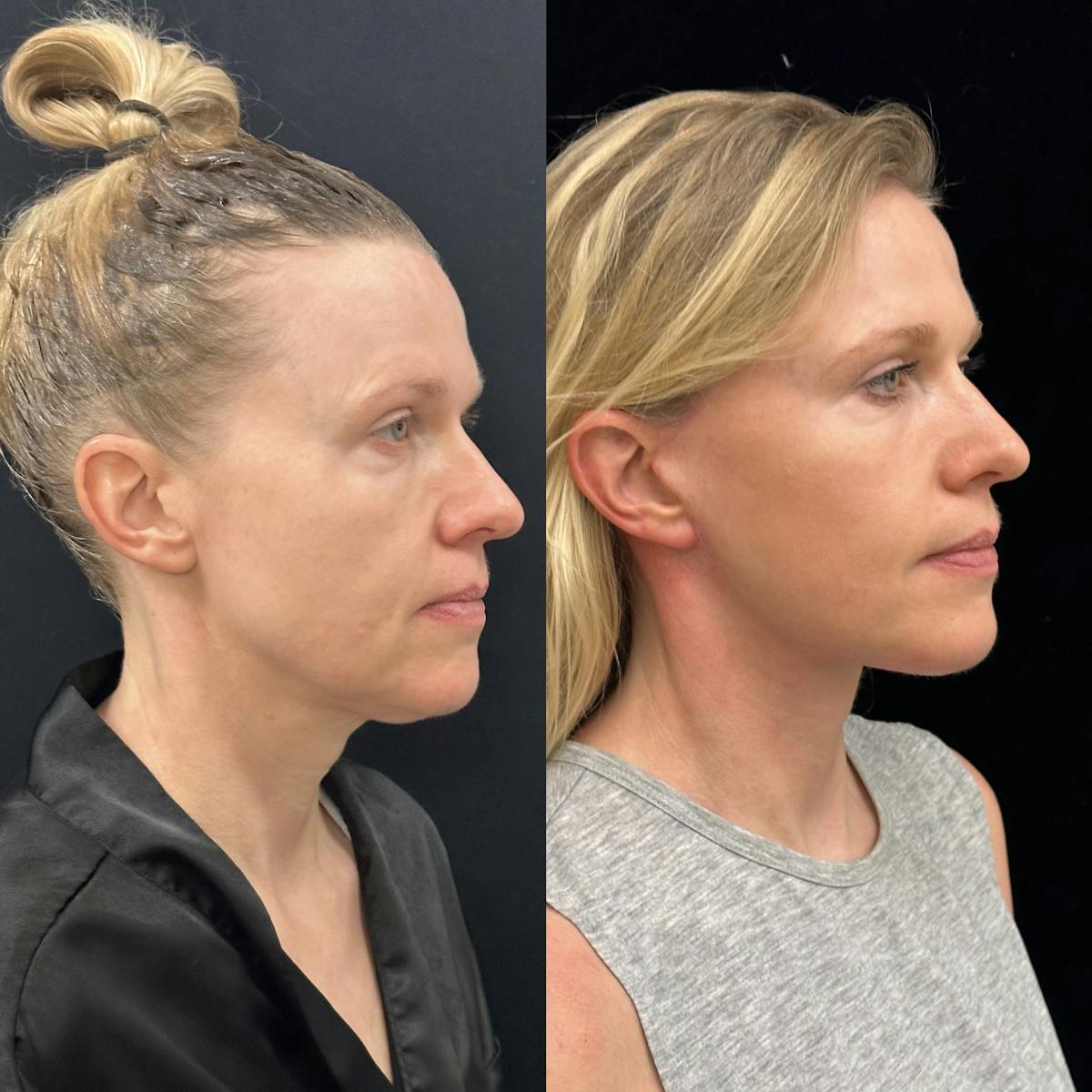 Deep Plane Facelift Before & After Gallery - Patient 240392 - Image 6