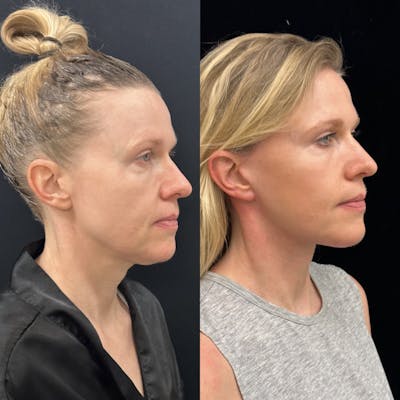 Deep Plane Facelift Before & After Gallery - Patient 240392 - Image 6