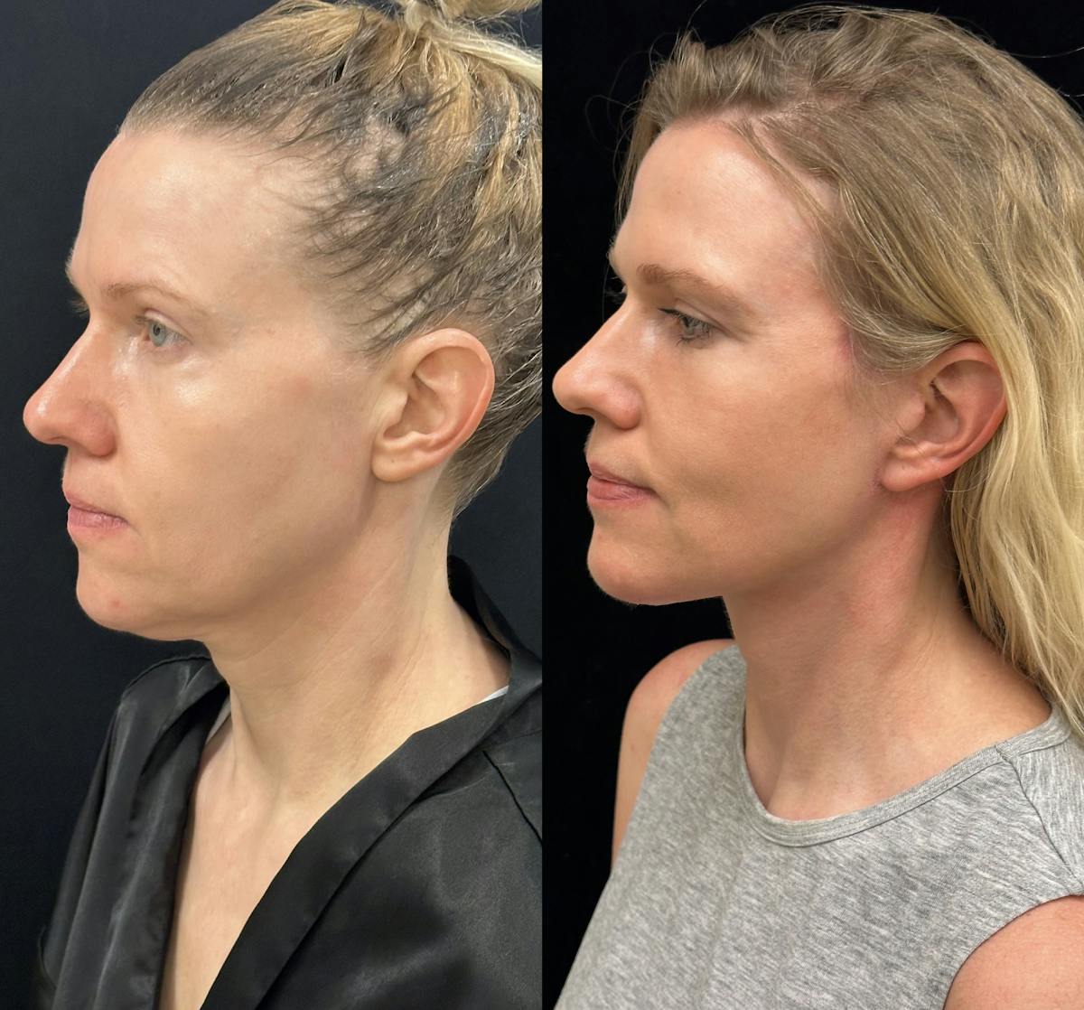 Deep Plane Facelift Before & After Gallery - Patient 240392 - Image 3