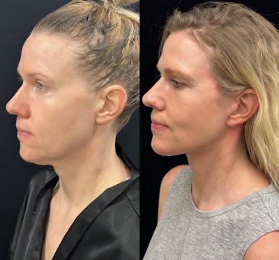 Deep Plane Facelift Before & After Gallery - Patient 240392 - Image 3
