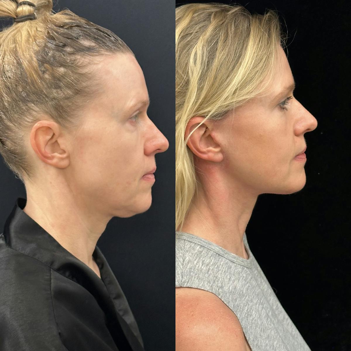 Deep Plane Facelift Before & After Gallery - Patient 240392 - Image 4