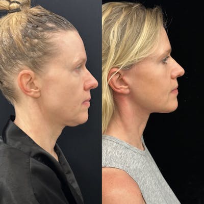 Deep Plane Facelift Before & After Gallery - Patient 240392 - Image 4