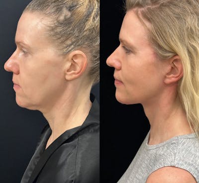 Deep Plane Facelift Before & After Gallery - Patient 240392 - Image 1
