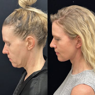 Deep Plane Facelift Before & After Gallery - Patient 240392 - Image 2
