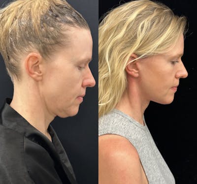 Deep Plane Facelift Before & After Gallery - Patient 240392 - Image 5