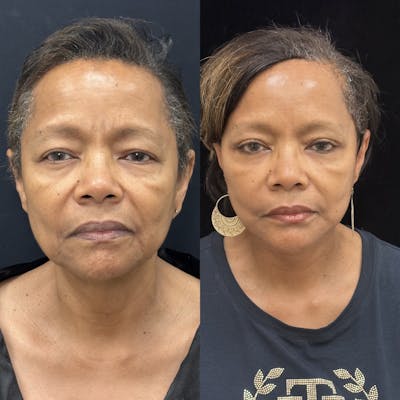 Deep Plane Facelift Before & After Gallery - Patient 131161 - Image 1