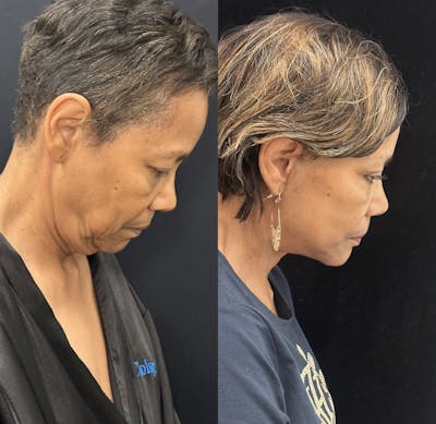 Deep Plane Facelift Before & After Gallery - Patient 131161 - Image 2
