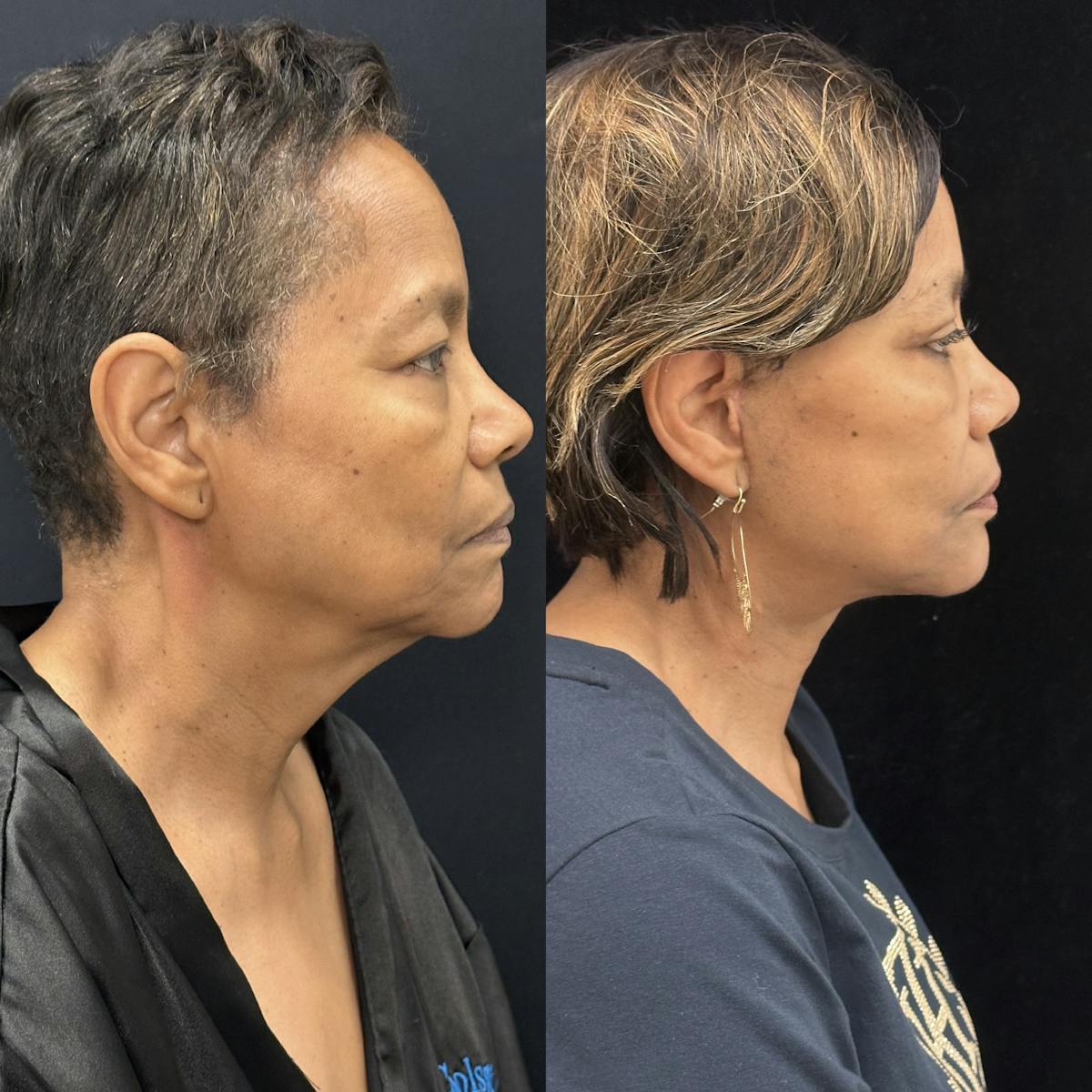 Deep Plane Facelift Before & After Gallery - Patient 131161 - Image 3
