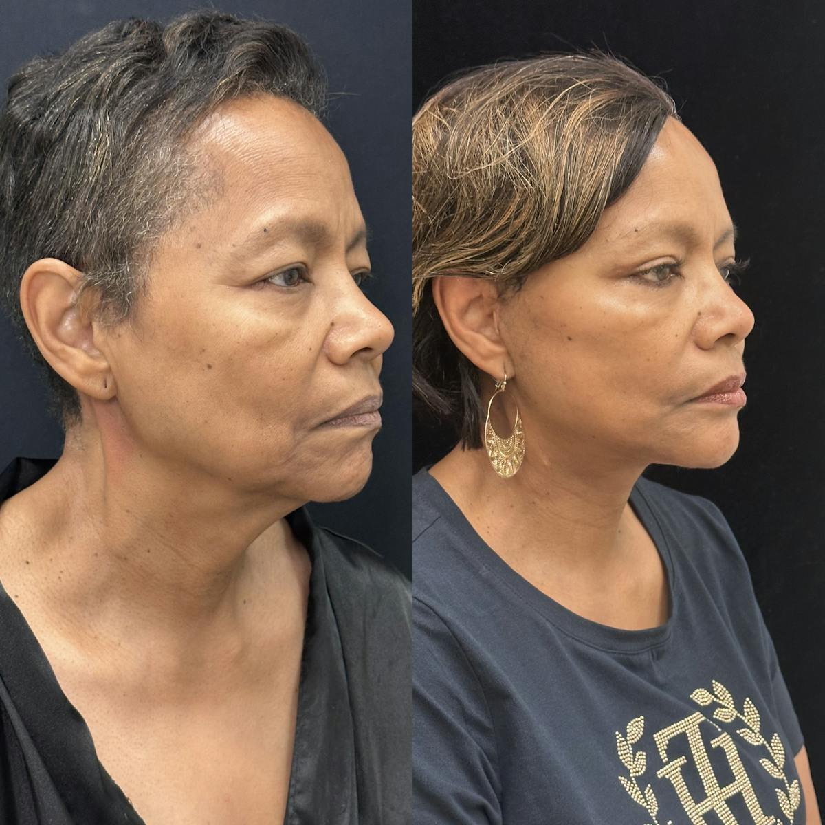 Deep Plane Facelift Before & After Gallery - Patient 131161 - Image 4