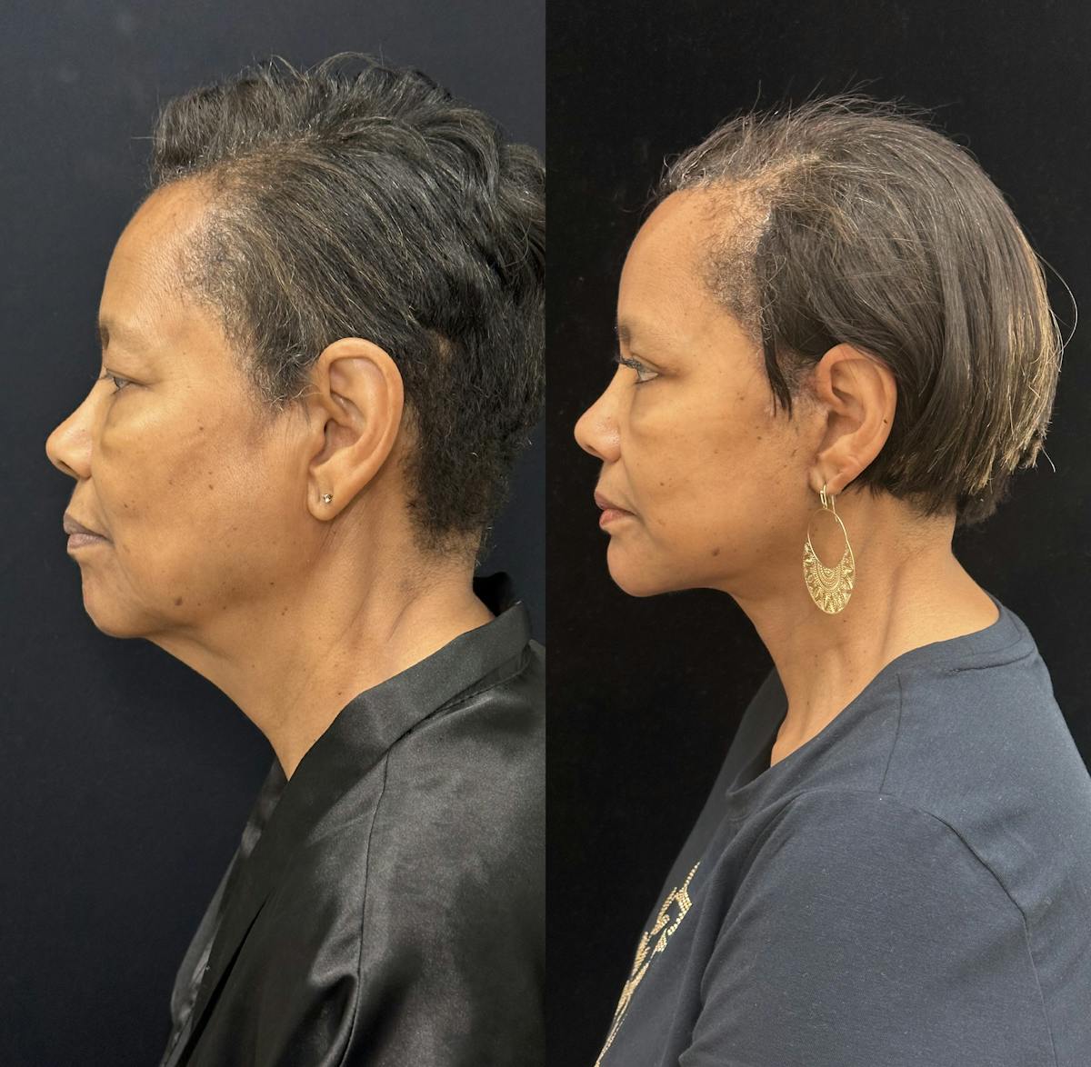 Deep Plane Facelift Before & After Gallery - Patient 131161 - Image 6