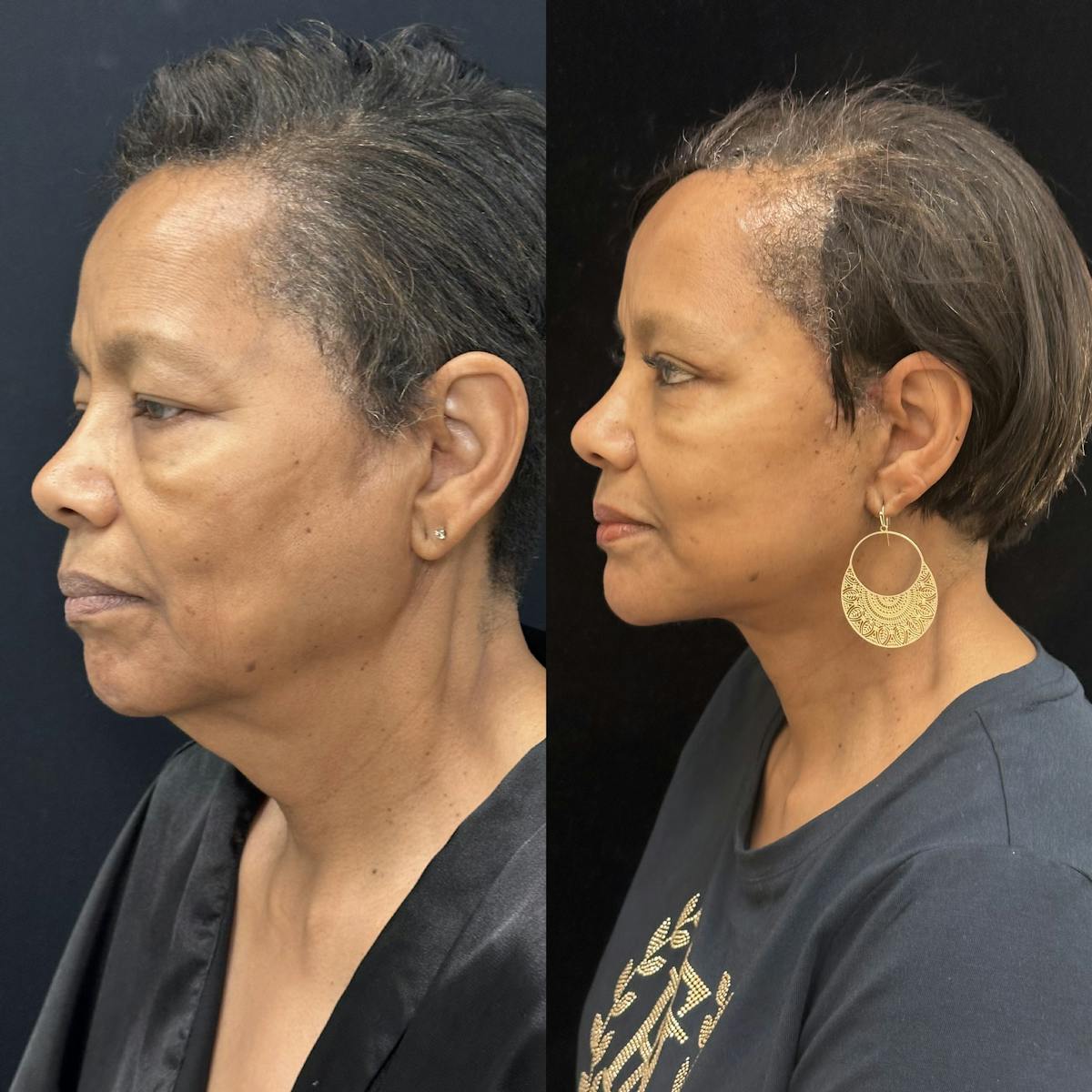 Deep Plane Facelift Before & After Gallery - Patient 131161 - Image 5