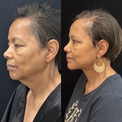 Deep Plane Facelift Before & After Gallery - Patient 131161 - Image 5