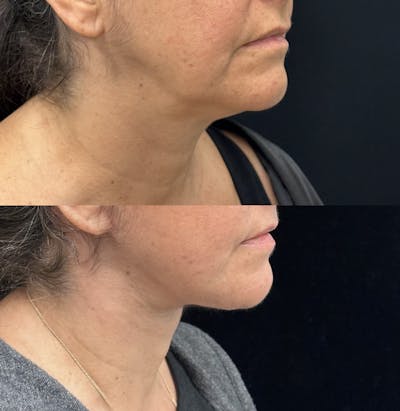 Deep Plane Facelift Before & After Gallery - Patient 429405 - Image 2