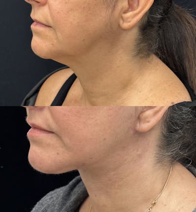 Deep Plane Facelift Before & After Gallery - Patient 429405 - Image 3