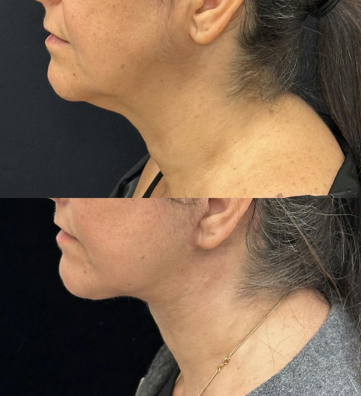 Deep Plane Facelift Before & After Gallery - Patient 429405 - Image 1