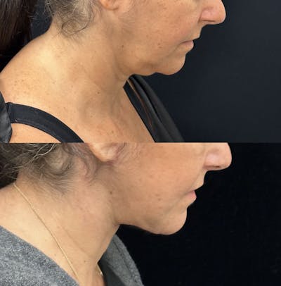 Deep Plane Facelift Before & After Gallery - Patient 429405 - Image 4