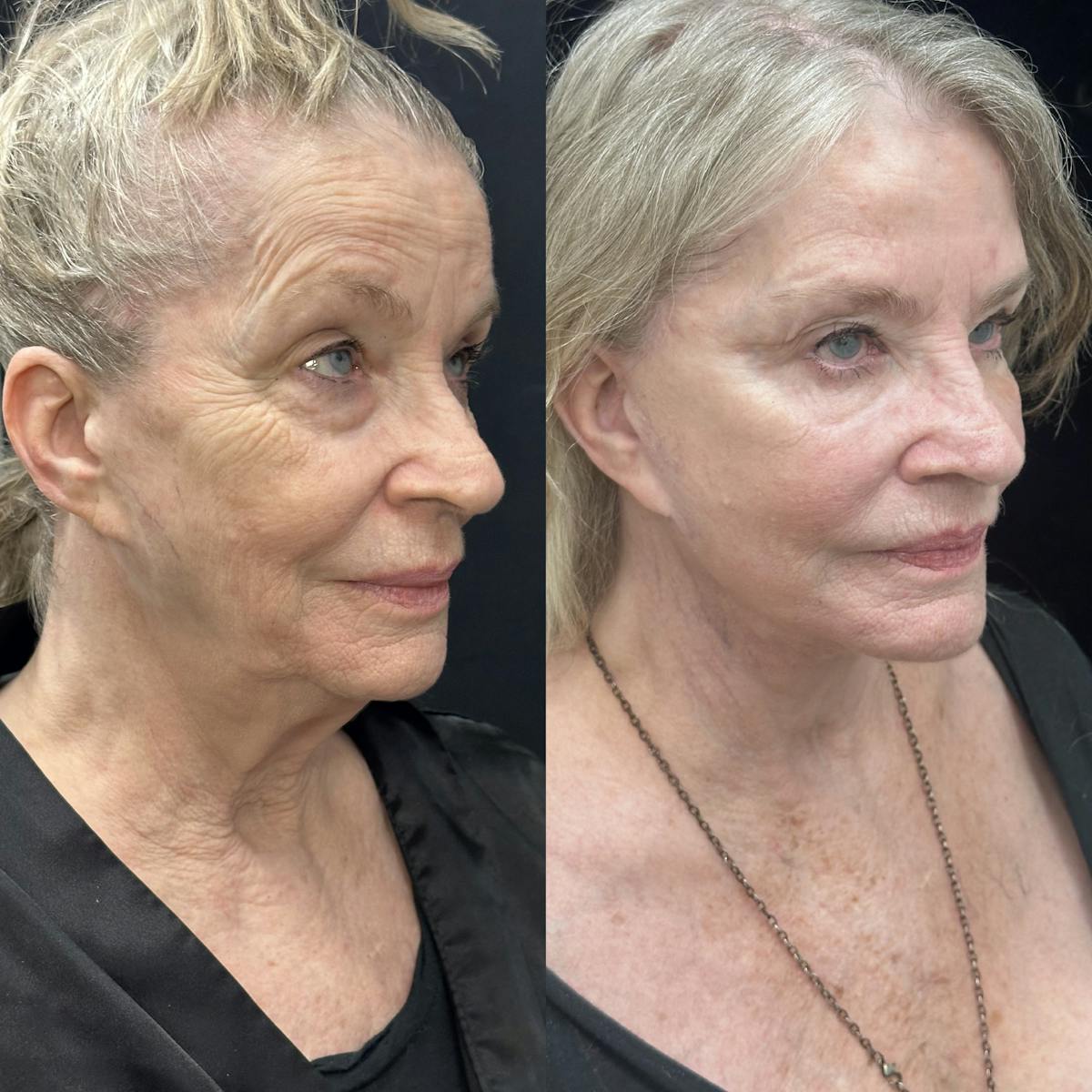 Deep Plane Facelift Before & After Gallery - Patient 140955 - Image 2