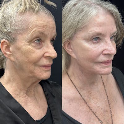 Deep Plane Facelift Before & After Gallery - Patient 140955 - Image 2