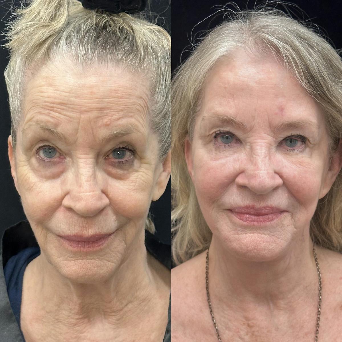 Deep Plane Facelift Before & After Gallery - Patient 140955 - Image 1