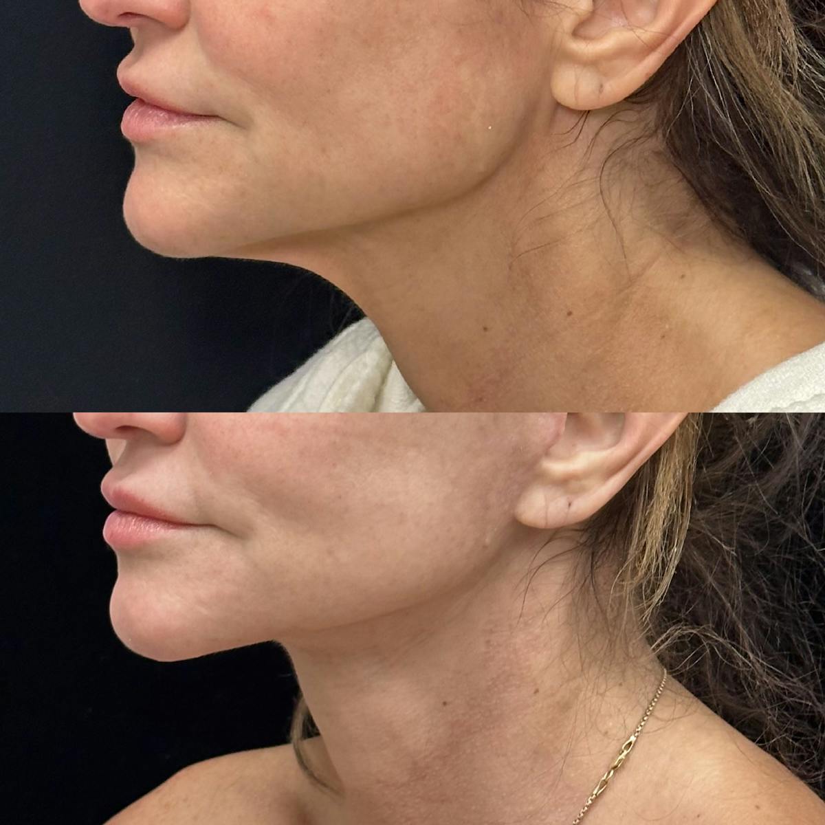 Deep Plane Facelift Before & After Gallery - Patient 216466 - Image 1