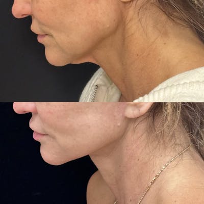 Deep Plane Facelift Before & After Gallery - Patient 216466 - Image 2