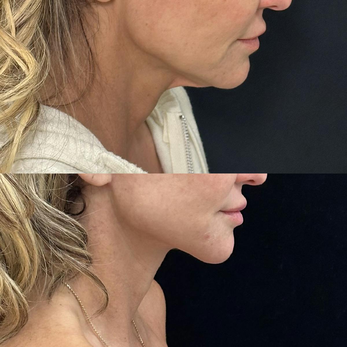 Deep Plane Facelift Before & After Gallery - Patient 216466 - Image 3