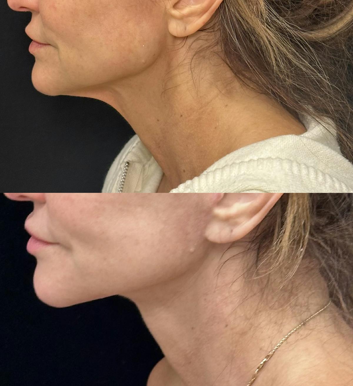 Deep Plane Facelift Before & After Gallery - Patient 216466 - Image 4