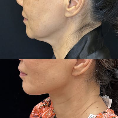 Deep Plane Facelift Before & After Gallery - Patient 269559 - Image 3