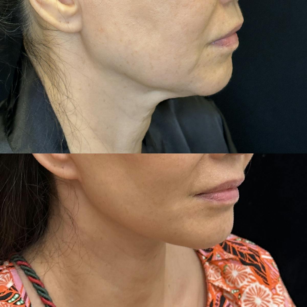 Deep Plane Facelift Before & After Gallery - Patient 269559 - Image 2