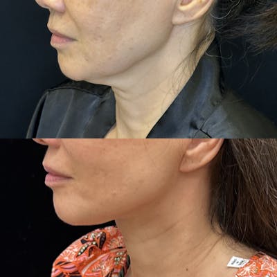 Deep Plane Facelift Before & After Gallery - Patient 269559 - Image 4