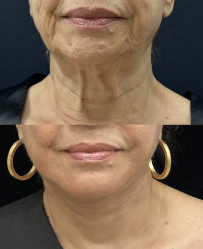 Deep Plane Facelift Before & After Gallery - Patient 712300 - Image 3