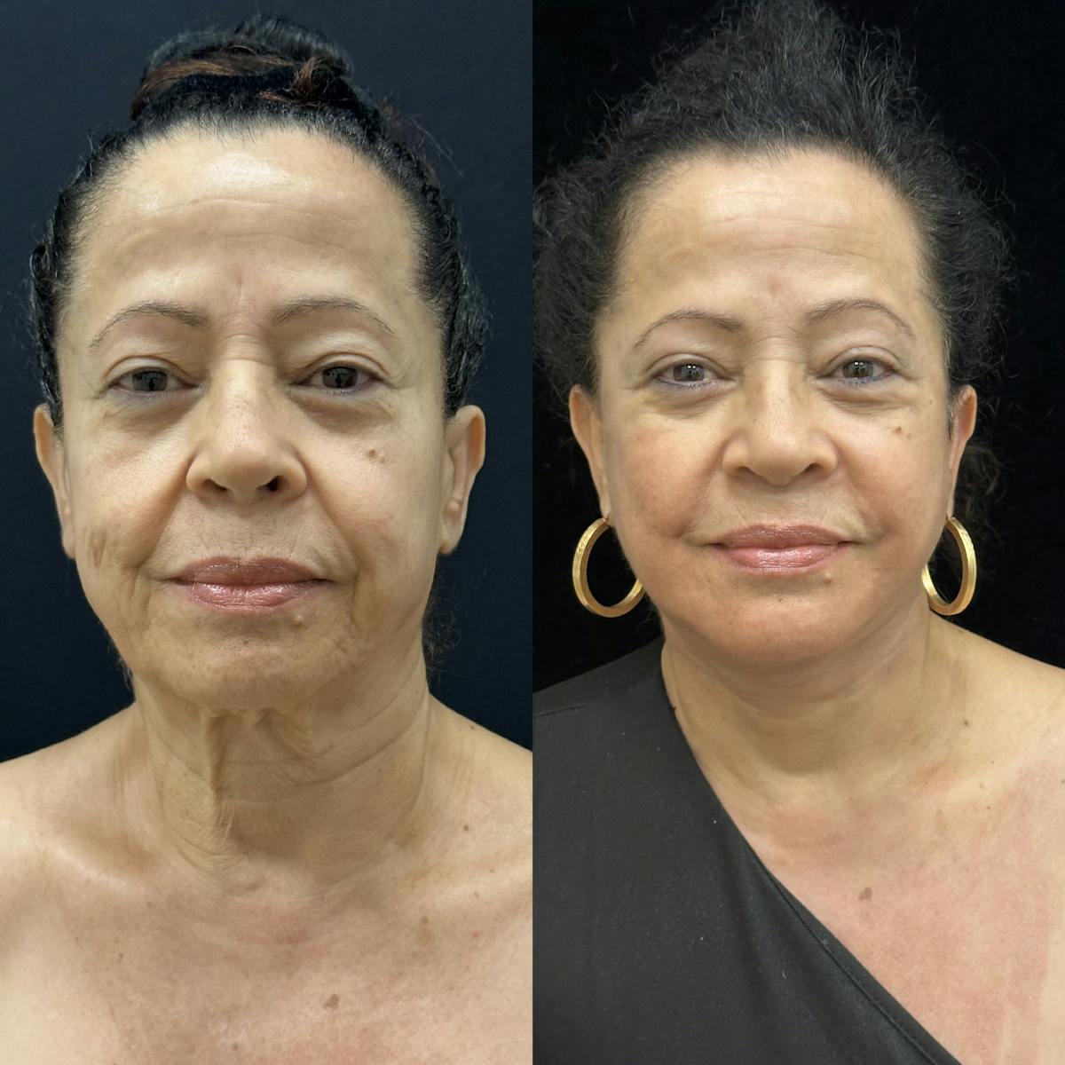 Deep Plane Facelift Before & After Gallery - Patient 712300 - Image 1