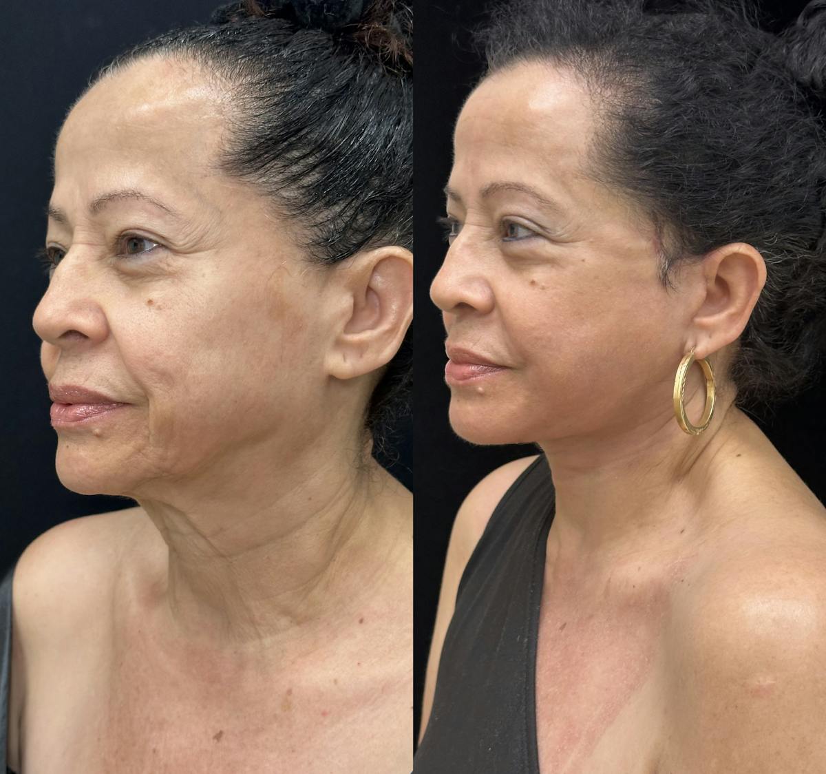 Deep Plane Facelift Before & After Gallery - Patient 712300 - Image 2